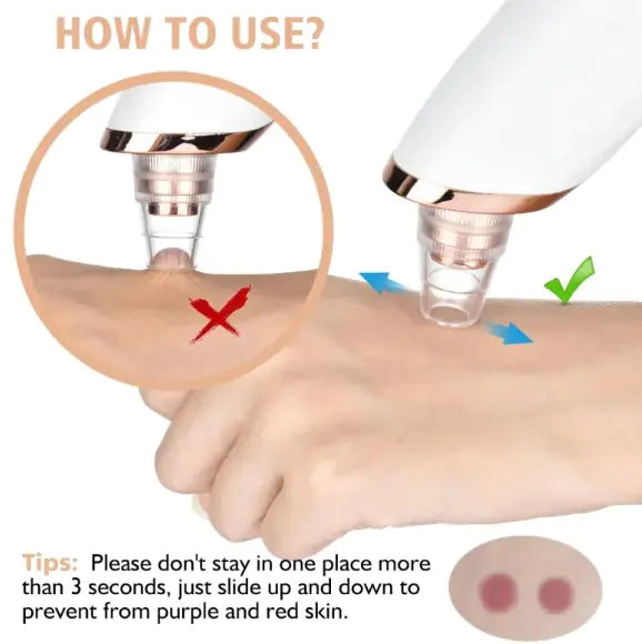Pore Perfect Pro Blackhead Vacuum Remover – Electric Pore Cleanser BeautyBond