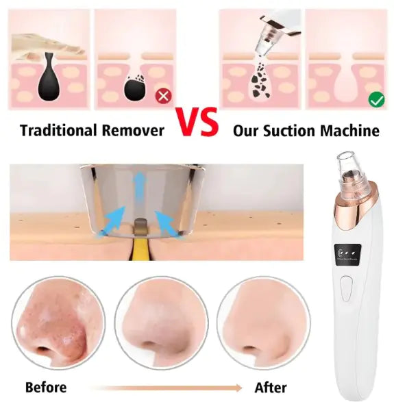 Pore Perfect Pro Blackhead Vacuum Remover – Electric Pore Cleanser BeautyBond