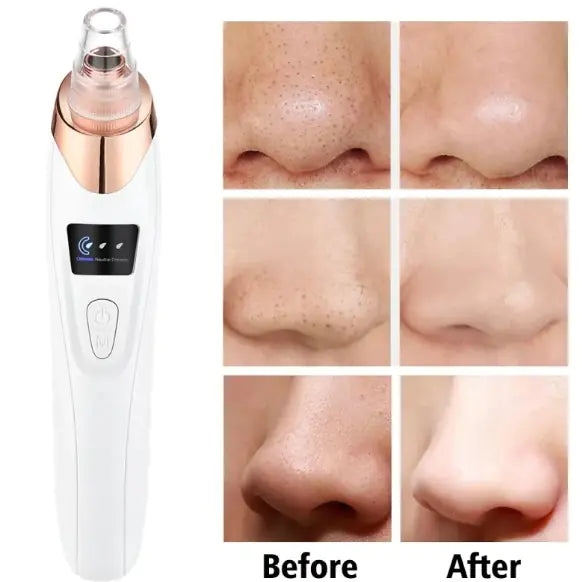 Pore Perfect Pro Blackhead Vacuum Remover – Electric Pore Cleanser BeautyBond